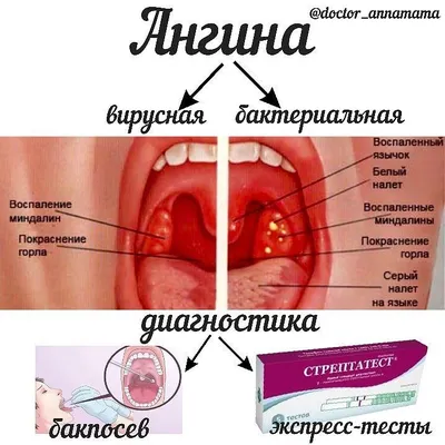 Это страшное слово «ангина» - Статьи - Клиника «C Нуля» (Здоровая семья)