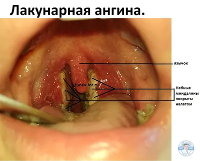 Ангина - ЛОР в Самаре - врач Лунёв Андрей Владимирович