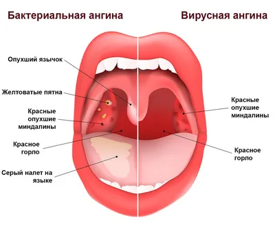 Герпангина — Википедия