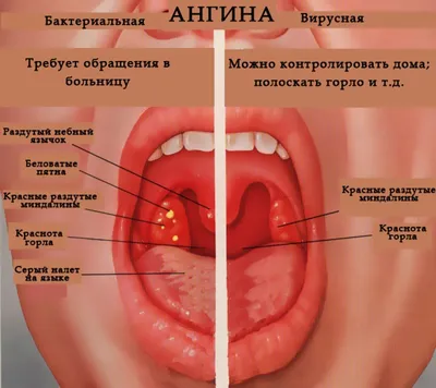 Гнойная ангина, чем лечить гнойную ангину, симптомы и признаки - блог  Furasol®