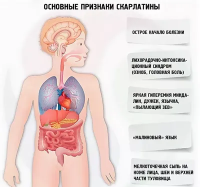 Катаральная ангина — статьи от отоларинголога в Москве