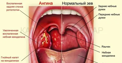 Грибковая ангина у детей: причины, симптомы и лечение