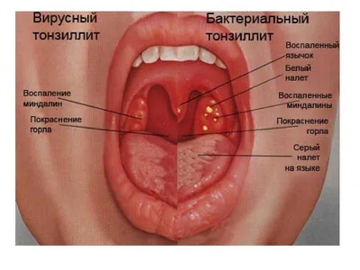 Ангина у взрослых - статьи от компании Еламед