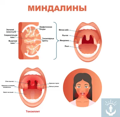 Стрептококковая ангина лечение, симптомы, инкубационный период, стрептококк  ангина — блог Furasol®