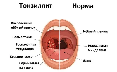 Ангина - лечение и симптомы, диагностика ангины в Москве, Клинический  Госпиталь на Яузе