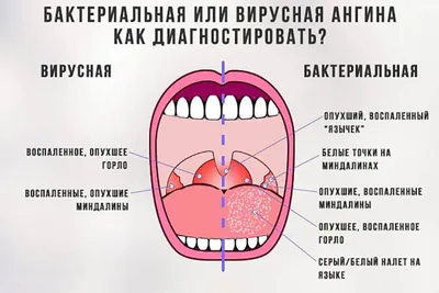 Гнойная ангина | Женский словарь | Дзен