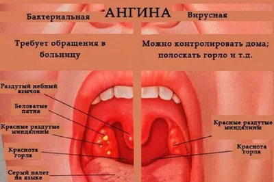 Вирусная ангина - лечение у детей и симптомы описаны в статье блога Furasol®