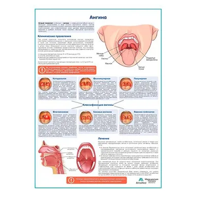 Ангина - что это за болезнь? | CorSwiss