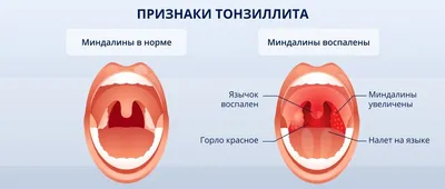 Красота Здоровье Массаж - Ангина у детей 👦 ⠀ 🔺Cимптомы обычной простуды:  -болит горло; -повышенная температура. ⠀ ✓Отличительные симптомы: ⠀  увеличение миндалин; белый налет на языке и в ротовой полости; болят глаза;