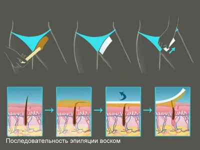 Что лучше: депиляция воском или шугаринг? | gladkO