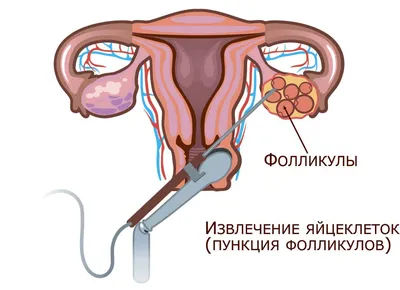 Процедура ЭКО: этапы, подготовка, сроки беременности после ЭКО