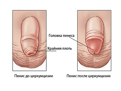 Фимоз у детей - что это такое? Надо ли лечить? МЦ Формула здоровье в Казани