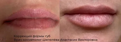 Dr. Mylips - Какая форма губ вам нравится больше всех?... | Facebook