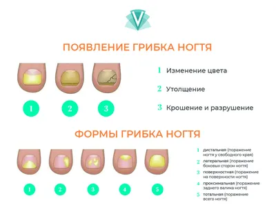 Грибок ногтей: причины, ранние симптомы и эффективные способы лечения |  Здоровье | WB Guru