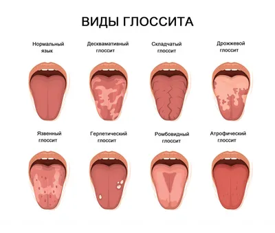 Географический язык - причины, этиология, виды, симптомы, диагностика,  лечение