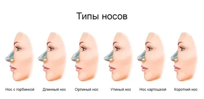 Как выпрямить курносый нос? Особенности ринопластики вздернутого носа