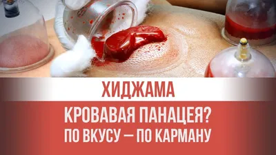 Универсальный аппарат al-Hijama для хиджамы, 12 банок+пистолет в Бишкеке  купить по ☝доступной цене в Кыргызстане ▶️ max.kg