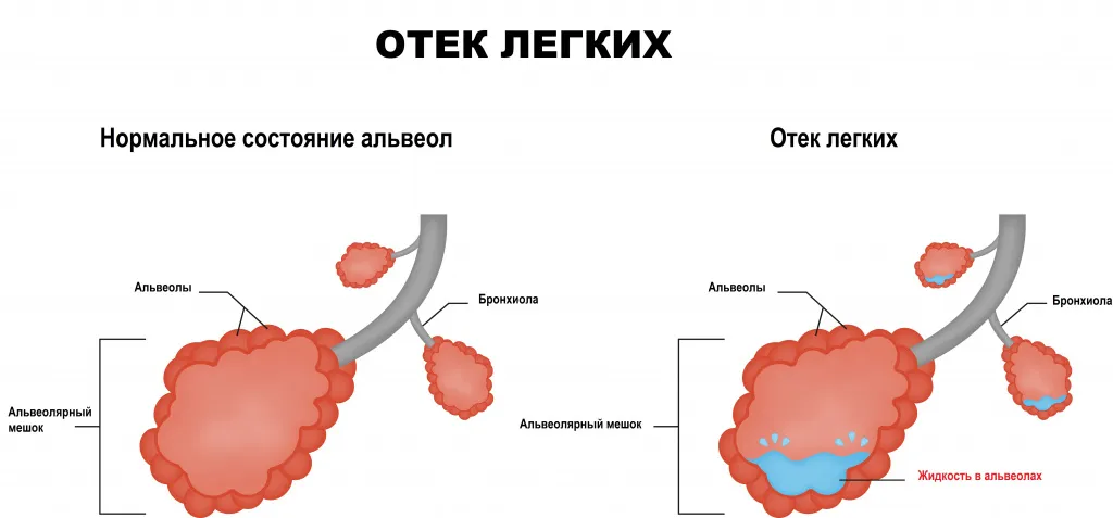 Кардиогенный отек легких патогенез. Отек легких этиология. Стадии отека легких. Механизм развития отеков.