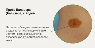 Лечение розового лишая (лишая Жибера) в Киеве — Derma.ua