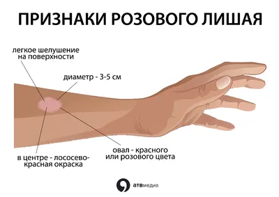 Разноцветный лишай: симптомы, причины, диагноз и лечение