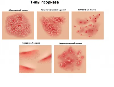 Псориаз: лечение в Ростове-на-Дону в медцентре Гераци