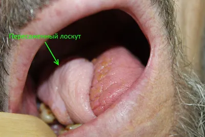 Врач-онколог назвал неочевидные признаки рака языка - МК Рязань
