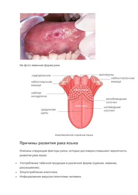 Борис: рак языка | NEOPLASTY