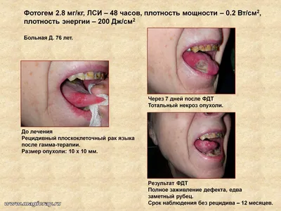 До рака доведет. Почему травмирование языка чревато опухолями? | Аргументы  и факты – aif.ru | Дзен