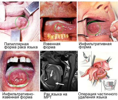 Что такое рак языка, симптомы и лечение рака языка