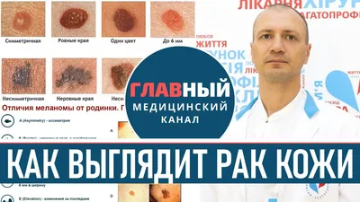 Рак кожи – что означает диагноз, которого боятся даже самые стойкие -  Медицинский центр \"Допомога+\"