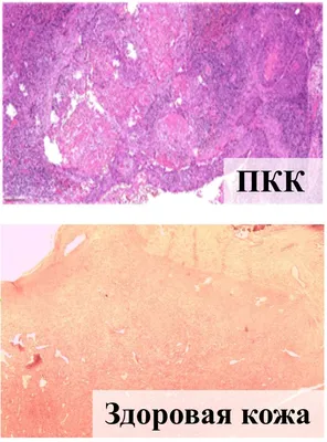 Рак Кожи Картинки