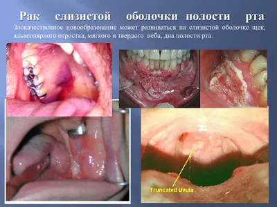 Строение верхней челюсти зубов человека