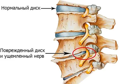 Гимнастика, ЛФК и комплекс лечебных упражнений при сколиозе