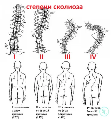 Комплексы упражнений ЛФК при остеохондрозе позвоночника: эффективные методы  лечения