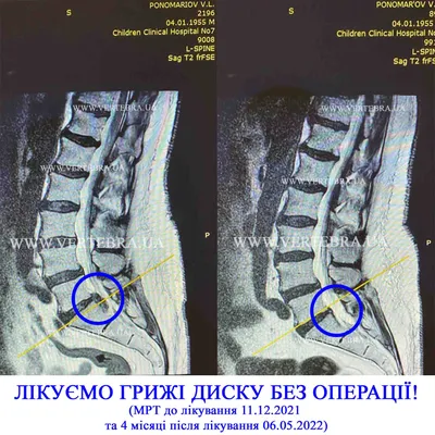 S-Образный сколиоз 1-2-3 степени, причины, лечение грудо-поясничного отдела  позвоночника