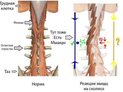 S-Образный сколиоз 1-2-3 степени, причины, лечение грудо-поясничного отдела  позвоночника