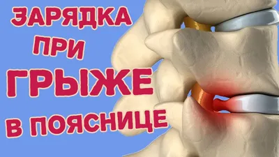 Грыжа С5–С6 шейного межпозвонкового диска, лечение, операция, симптомы