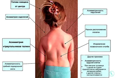 Упражнения При Сколиозе В Картинках