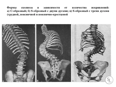 Пилатес при сколиозе - общие сведения, рекомендации, упражнения