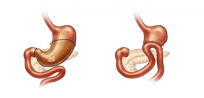 Размер желудка после резекции - Национальная бариатрическая практика