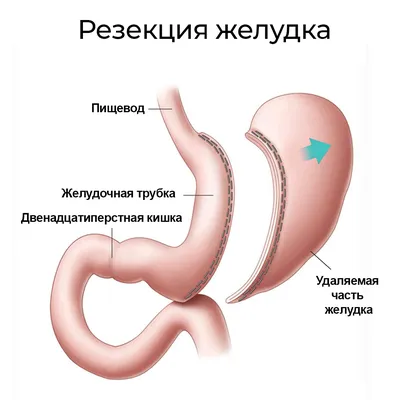 Операция шунтирования желудка: для похудения, цена, результат