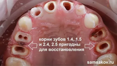 Статья о стоматологии: Лечение молочных зубов