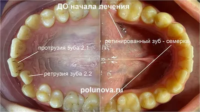 Почему нужно лечить молочные зубы