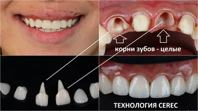 Как восстановить зуб если остался только один корень | Альянс  бьюти-ортопедов, Москва