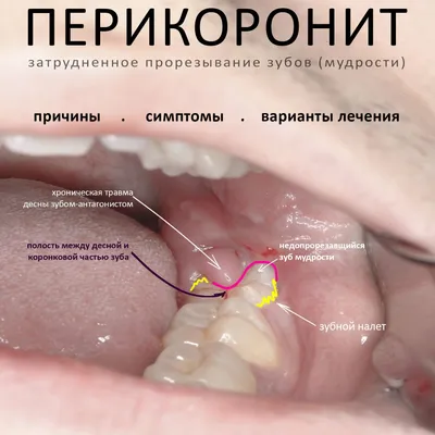 Почему мог почернеть зуб?