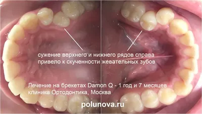 Фото подборка удаленных зубов мудрости (591) - Юмор, релакс - Новости и  статьи по стоматологии - Профессиональный стоматологический портал (сайт)  «Клуб стоматологов»