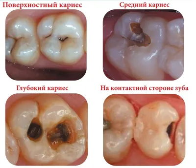 Зубной штифт – установка, плюсы и минусы