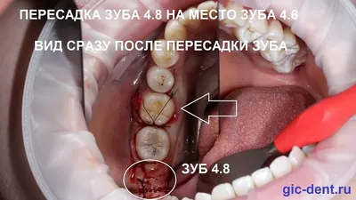 Кариес \"дырка\" в зубе. Как обнаружить и зачем нужен рентгеновский снимок?  Некариозные поражения. | Правдивая стоматология доктора Аболмасова | Дзен