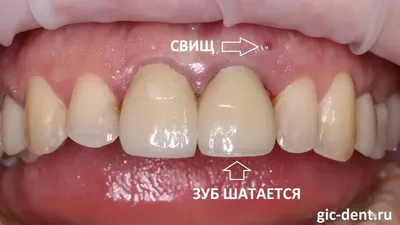 Имплантация собственных зубов. Пересадка зубов мудрости в ТОП1 клинике  Москвы – Немецкий имплантологический центр