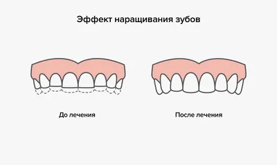 Киста зуба - что это, причины кисты зуба, стадии, симптомы, виды и лечение  кисты